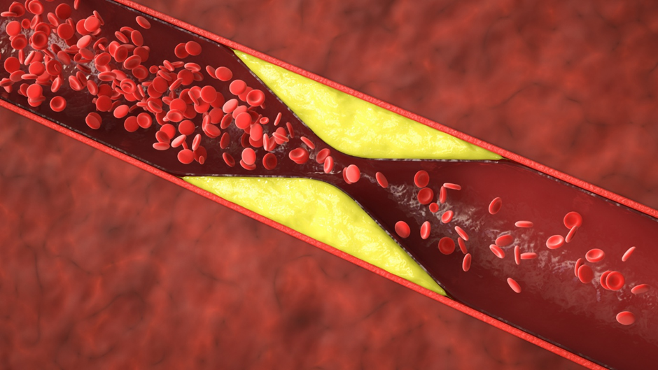 Figure 4 Atherosclerosis, caused by plaque buildup in arteries, is linked to processed food and poor diet&mdash;Paleo nutrition emphasizes heart-friendly, anti-inflammatory foods.